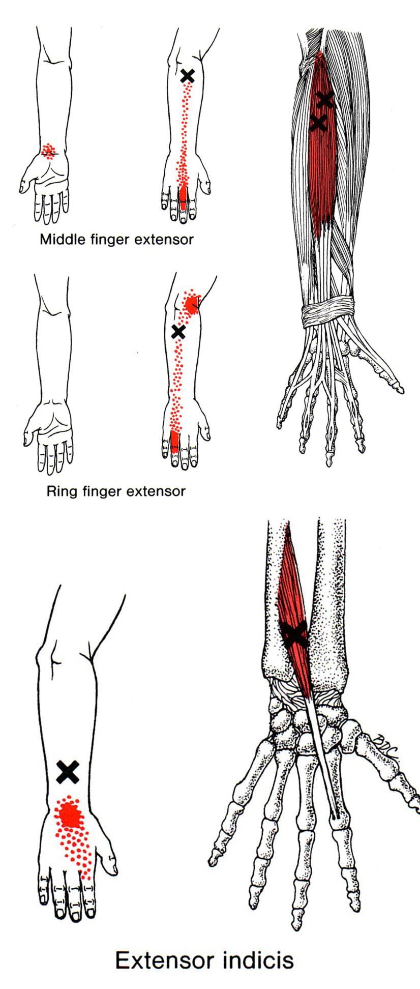Extensor Digitorum The Trigger Point Referred Pain Guide